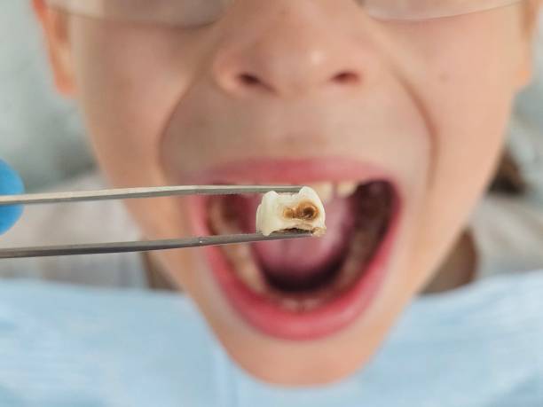 Best Emergency Dentist for Knocked-Out Tooth in Marquette, MI